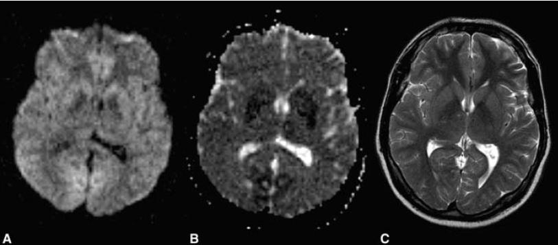 MRI Diffusion-weighted image, ADC, Just T2