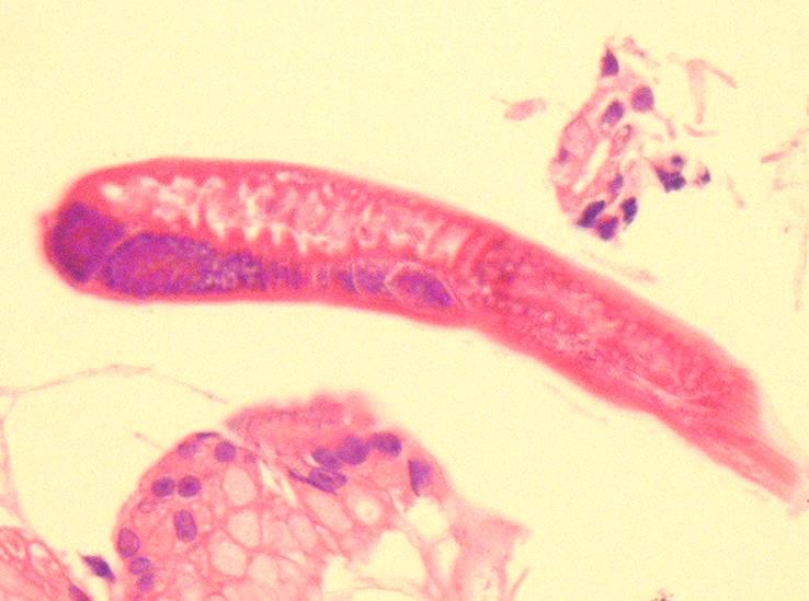 infiltrates and rhabditiform larvae. Figure 3.