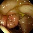 Dig Liver Dis 2005;37:62-64 Surgery due to acute abdomen (M/33) 홍어회 ( 쓸개 )