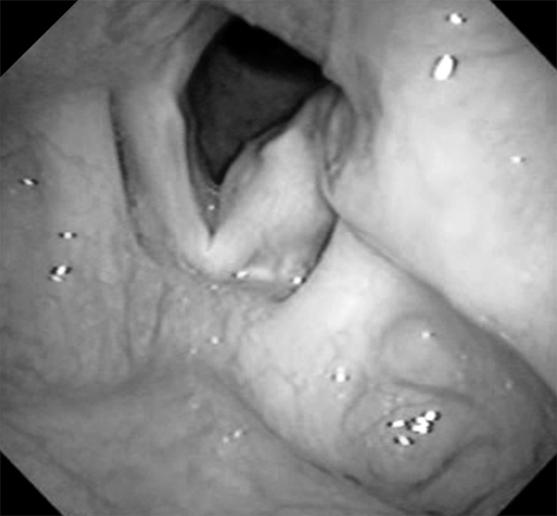 갑상선수술후음성변화의진단및치료 Fig. 2. Algorithm for unilateral vocal fold paralysis after thyroidectomy. Fig. 3. Left vocal cord paralysis before (A) and after (B) injection laryngoplasty.
