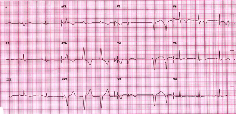 A B Figure 1. Baseline ECG on admission (A) and follow-up (B). A.