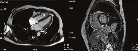 Figure 2. Documented monomorphic ventricular tachycardia with left bundle branch block configuration on 24 hours Holter recordings. A B Figure 3.