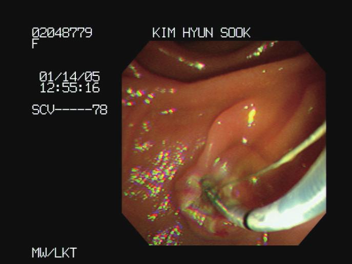 20 2013 gastroenterology Winter School CBD stone extraction after EST Jaundice Patient in ER Obstructive