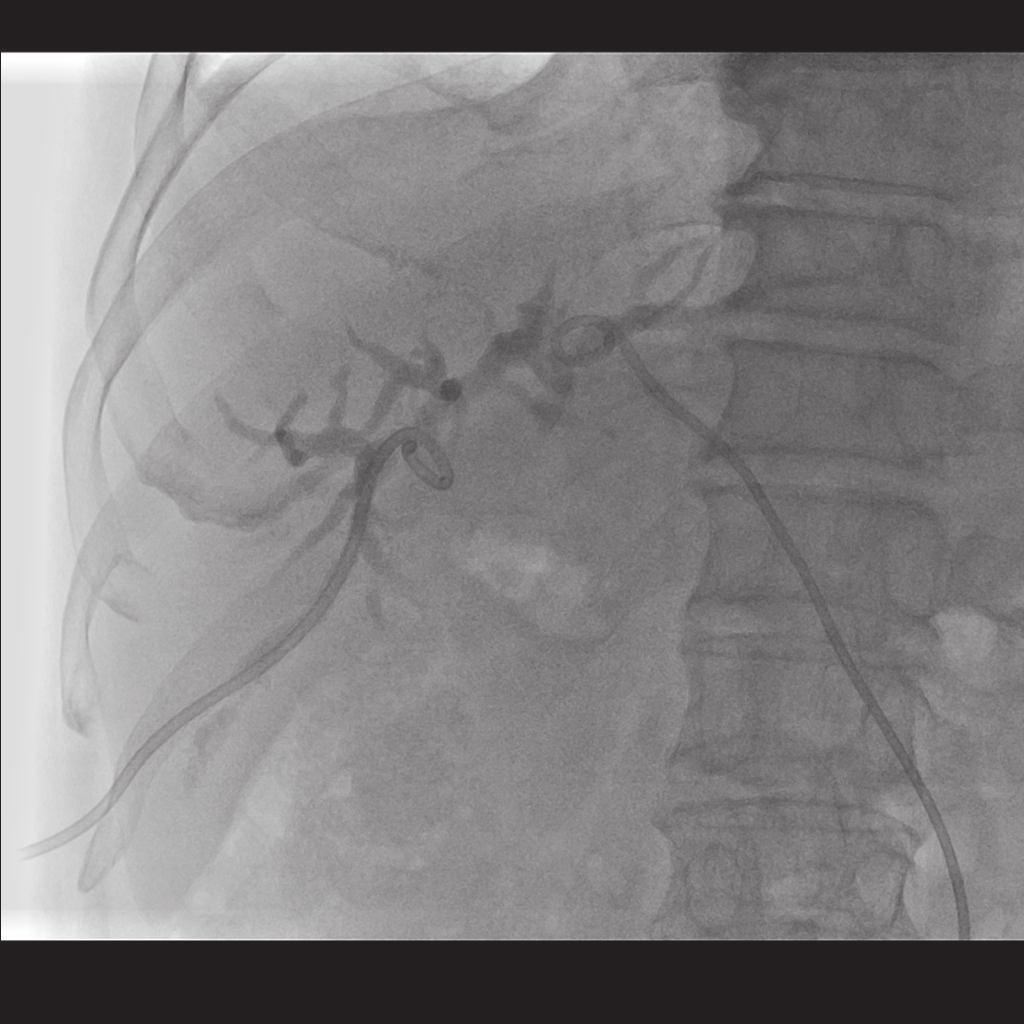 US or CT dilated bile duct ERCP or PTC Drainage procedure in malignant obstruction - PTBD in