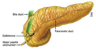 32 2013 gastroenterology Winter School Alcoholic pancreatitis 수년간에걸친알코올섭취에의해발생 하루평균 60 gm, 3 년이상, 1 주내음주 증상은처음이라도조직학적으로는만성변화