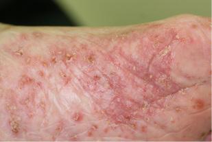 Reemerging skin disease caused by arthropods I: scabies 의학강좌 Figure 7.