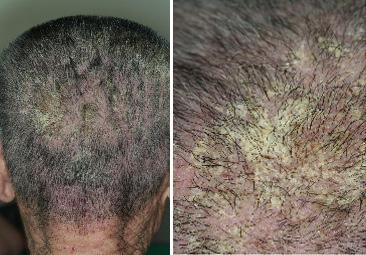 Crusted scabies showing seborrheic dermatitis-like yellowish hyperkeratotic patches on the scalp in a 86-yearold man admitted in an