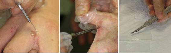 Reemerging skin disease caused by arthropods I: scabies 의학강좌 Figure 12. Procedures of scraping for scabies using mineral oil. 포제를선택하고가족은물론신체접촉 이있었던모든사람이함께치료를하 는것이중요하다.