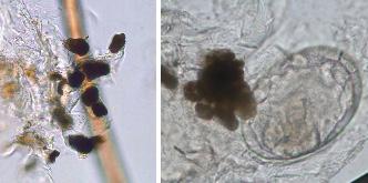 Scybala and a vellus hair (A), and scybala and an egg (B) of Sarcoptes scabiei. 할수있으며 2차세균감염이있을경우 적절한항생제를병행투여하여야한다. 다각화증으로두꺼워진각질층내에벌집과같이층층으로 흔히사용되는항옴진드기제는다음과같다. 형성된터널내에서모든발육단계의옴진드기를볼수있다 (Figure 15).