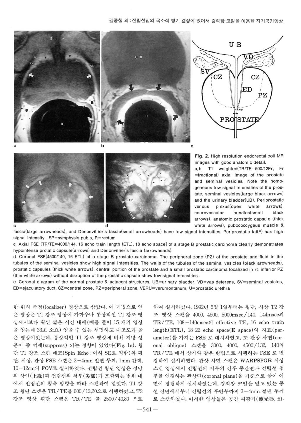 김종철외 : 전립선암의국소적병기결정에있어서겸직장코일을이용한자기공명영상 a b e Fig. 2. High resolution endorectal coil MR images with good anatomic detail a, b.