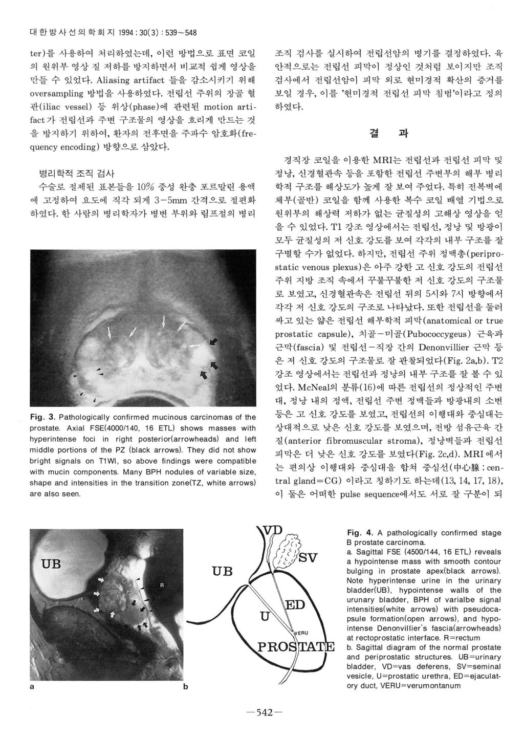 대한방사선의학회지 1994: 30(3) : 539-548 ter) 를사용하여처리하였는데, 이런방법으로표면코일의원위부영상질저하를방지하면서비교적쉽게영상을만들수있었다. Aliasing artifact 들을감소시키기위해 oversampling 방법을사용하였다. 전립선주위의장골혈 조직검사를실시하여전립선암의병기를결정하였다.