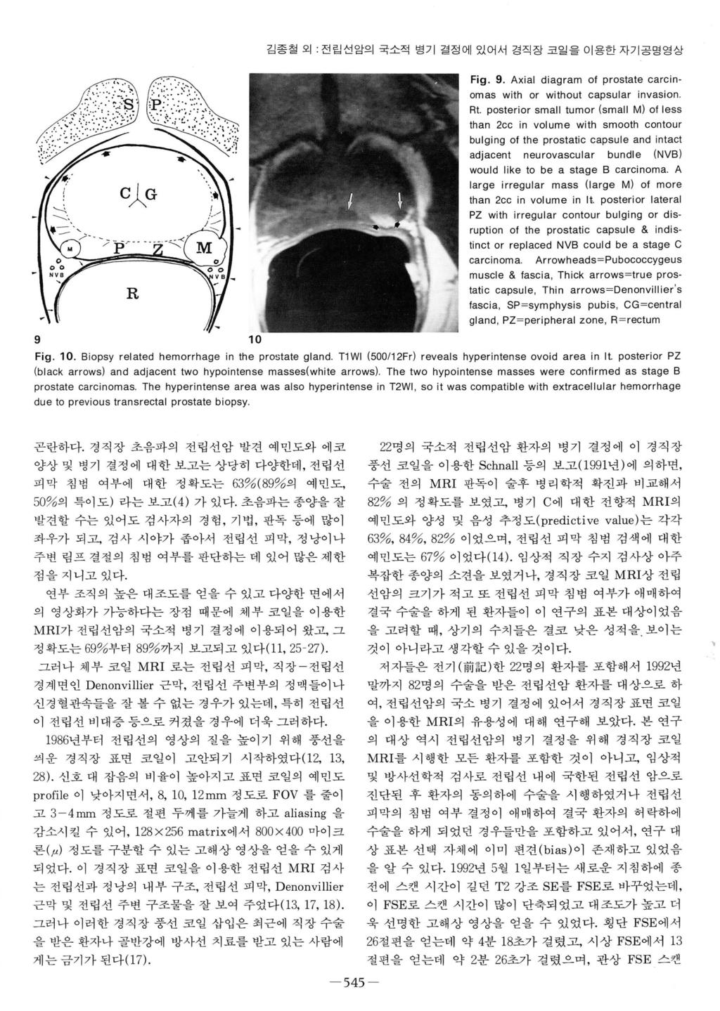 대써김종철외 전립섣암의국소적병기결정에있어서경직장코일을이용한자기공명영상 9 10 Fig. 9. Axial diagram 01 prostate carcin mas with or without capsular invasion Rt.