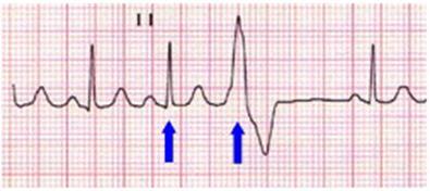 Mechanism of arrhythmia(1) Automaticity