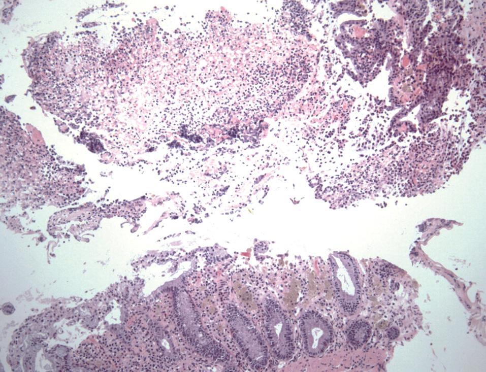 Young-Jin Yoon, et al: Difficult Evaluation of Pseudomembranous Colitis in Old Age Fig. 4. A mushroom-like mass of mucus and neutrophils attached to the surface of the mucosal glands is present.