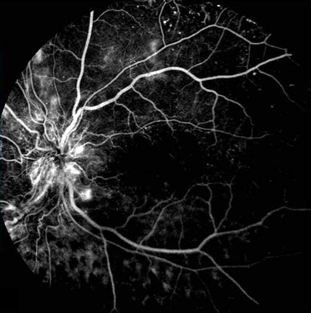 () Early phase fluorescein angiography shows the optic-disc leakage due to neovascularization. C D Figure 2.