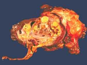Kidney cancer Most frequent: Renal cell cancer (adenocarcinoma)