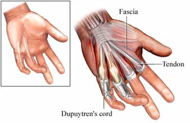 연부조직의촉진 (soft tissue palpation) 8) 손제 3 구역 ; 손바닥 (palm) (1) 수장건막 (palmar aponeurosis) - Dupuytren s contracture http://img.webmd.