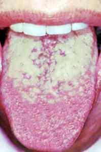 구취의원인 ora origin 설태 (tongue coating) 1. 85-90% 이상이구강으로부터기원한다. 2. 구취는대개세균에의한부패로인해생성된다.