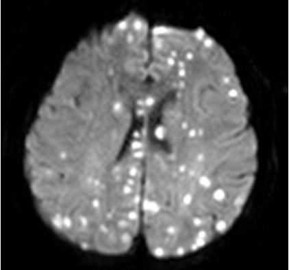 - Kwang Jin Chun, et al. A case of liver abscess due to Lactococcus lactis - 있다 5-10). 본저자는건강하게지내다갑작스럽게발생한의식저하를주소로내원한 43세여자에서 Lactococcus로인한간농양 1예를경험하였기에문헌고찰과함께보고하는바이다.