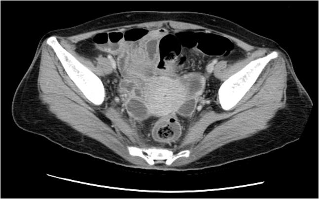 - 대한내과학회지 : 제 77 권부록 5 호 2009 - Figure 3. Abdominal CT shows tortuous cystic lesions in both adnexa areas in the pelvic cavity. 기시작하였다.