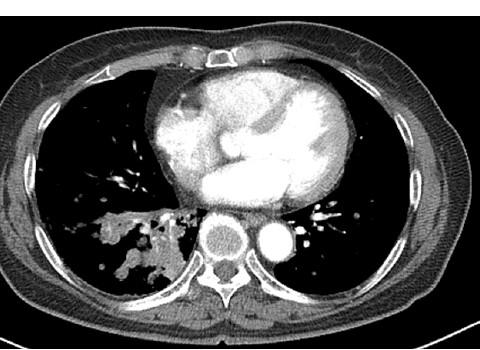- Sung Yong Lee. Molecular diagnosis and treatment of non-squamous lung cancer - A B Figure 1. (A) Chest X-ray and (B) computed tomography scans. A 5.