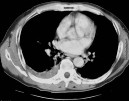 mediastinum. Figure 3.