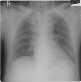 amount of hemopnemothorax at