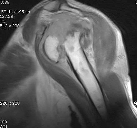 rotator cuff tears with retraction and