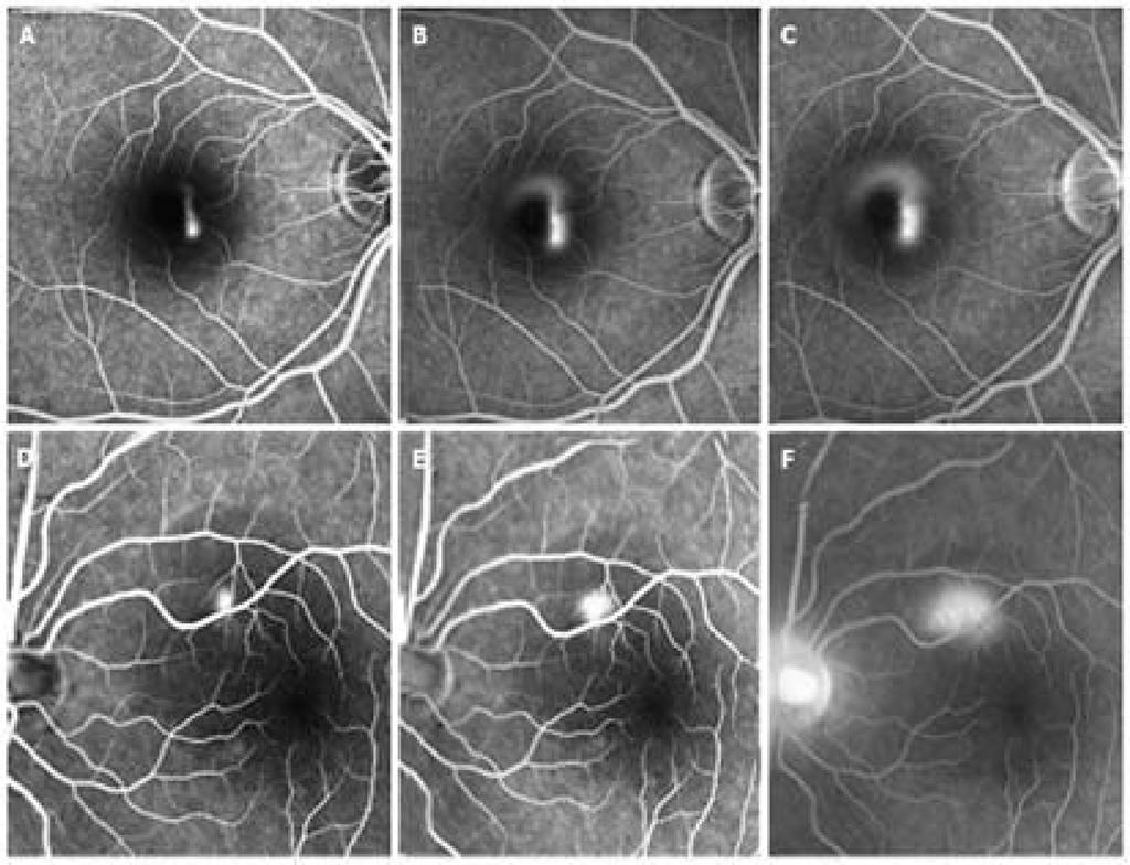 The Analysis of Optical Quality in Central Serous Chorioretinopathy by OQAS 283 Fig. 2. Hyperfluorescent dye leakage on fluorescein angiogram in acute central serous chorioretinopathy. A, B, C.