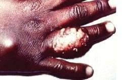 감염부위에따른진균증의종류 피하조직진균증피부를투과하여피하조직에감염증을일으킨다.