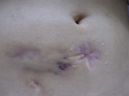 (B) The progressively healing wound site with pigment and scar. (+++) 으로 나와신속항산균동정검사를시 행하였으며 M. abscessus가검출되었다.
