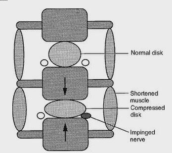 intervertebral space