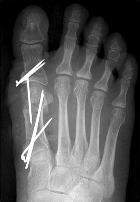 Akin 족지골 절골술(Akin phalangeal osteotomy) Beischer 등 은 삼차원 컴퓨터 측정법을 이용하여 변형 Ludloff Akin 족지골 절골술은 단독으로 시행하기보다는 중족골 절골술 절골술의 이상적인 지표를 제안하였다.