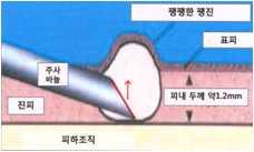 마 PPD가밖으로많이흘러나왔거나팽진이전혀생기지않았다면, 반대쪽전박에다시실시하거나, 같은쪽이면이전주사부위에서 5cm를띄어다시실시바 수두나 MMR