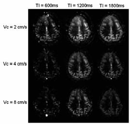 efficiency (~80% versus ~70% for AM control) 2X SNR improvement Total 5X SNR gain With background suppression >10X SNR gain VSASL 방법 : blood