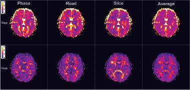 AKC in Human Brain DTI 구조물질들의비등방성 (Anisotropy) 확산현상을기술 rotationally invariant scalar (RIS) 량 : 어떤방향으로영상을획득하든지관계없이확산값은변하지않음 환자간의확산을비교할수있는것이특징 RIS index: Isotropic diffusion: Trace (mean diffusivity)