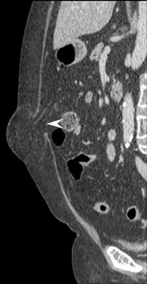 제주위탈장은배꼽주변의백선 (linea alba) 의결손을통해생기는것으 Fig. 3. 76-year-old woman with hepatocellular carcinoma.