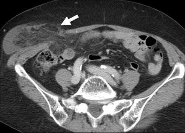 ). 요 Fig. 4. 74-year-old man with palpable mass on right flank.