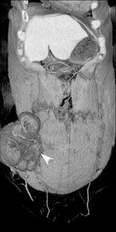 . Coronal reformatted image reveals herniated ascending colon through superior lumbar triangle