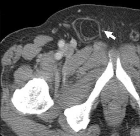 Fig. 8. 83-year-old man with vomiting, nausea and palpable mass in right inguinal area.