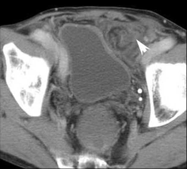 ,. xial MDCT scan show dilatation of small