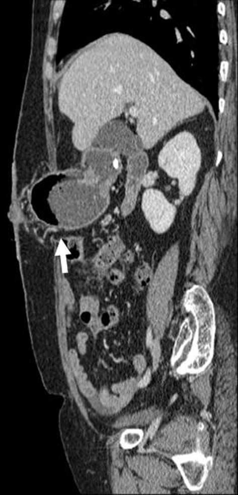 장루주위탈장 장루주위탈장은복벽절개부탈장의일종으로장루 (stoma) 에인접해서생기며비만, 영양실조, 기침등에의해잘발생한다. 임상적진단이어려워전산화단층촬영술로탈장된내장을확인하는것이유용하다 (1, 2) (Fig. 15, ).