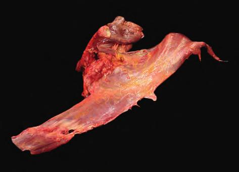근막경선해부학 natomy Trains 슬괵근의슬와부근의건건 (Hamstring tendon) 소통섬유군 [Communicating fibers ( 근육근막경선체계의요소 )] 천추근막천골근막 (Sacral fascia) 흉추상부극돌기군 (Upper thoracic spinous processes) 의위치와방향 전거근 (Serratus anterior)