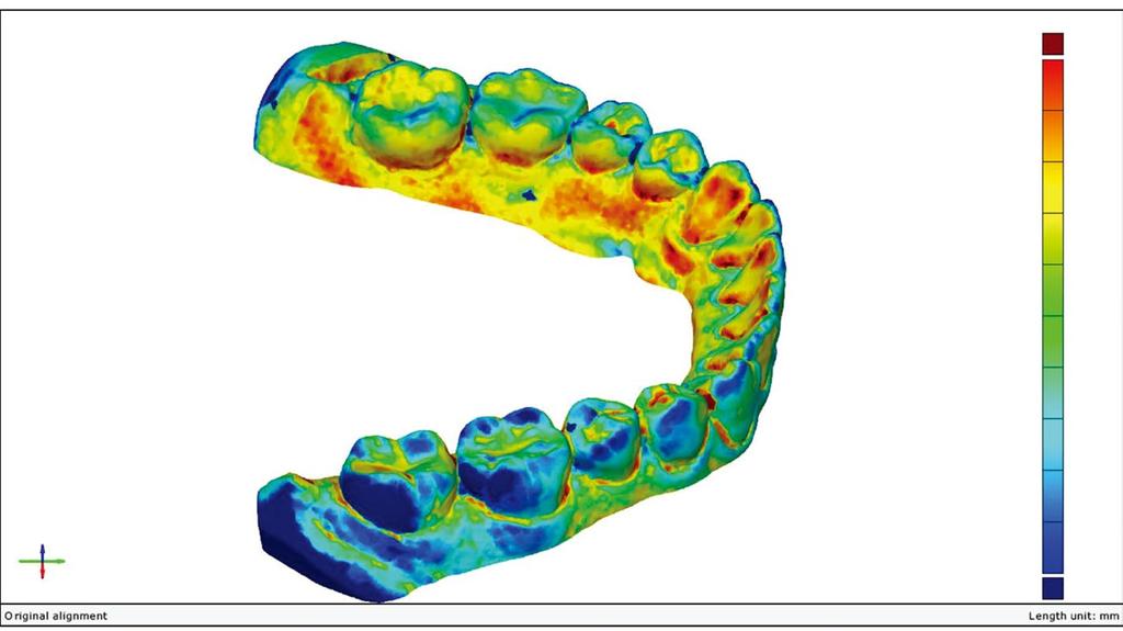 Three-dimensional deviations etween test and reference STL file. Generated following prealignment y Gom inspect softwa re. Color-coded scale shows discrepancy of superimposition (mm). Tale 1.