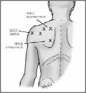 승모근부위통증 Trigger point ( 통증유발점 ) Trapezius muscle ( 승모근 ) Infraspinatus