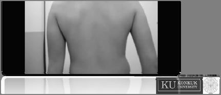 migration of scapula Type 4 (=Normal) no prominence of inferior angle or