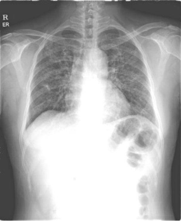 Diagnosis and Treatment of HP Figure 4.