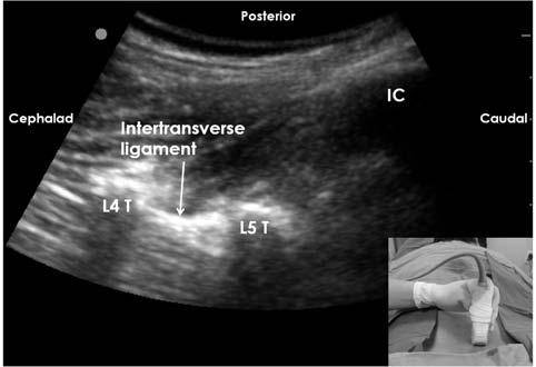 Fig. 11. Pararadicular approach of lumbar nerve root block. The lower right picture shows how transducer is positioned.