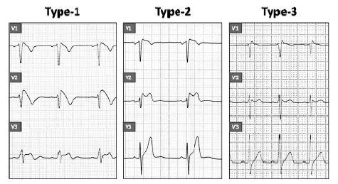 -Brugada 증후군환자의경접형동선종절제술을위한마취경험 - Fig. 2. Three different ECG patterns in the right precordial leads are frequently observed in patients with Brugada syndrome. 분절상승이 1 mm 이하인경우이다 2) 