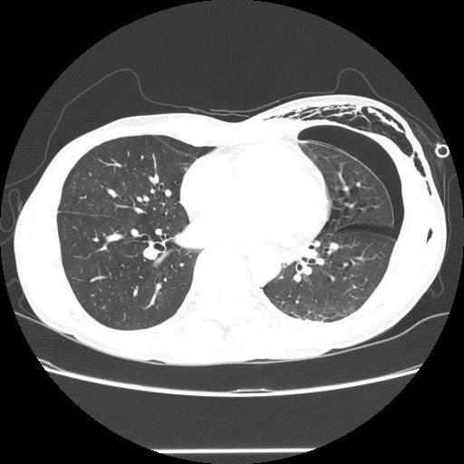Pleural biopsy showed extensive eosinophil infiltration of the pleura with pleural thickening and reactive mesothelial hyperplasia,